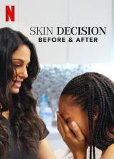 Skin Decision : Before And After